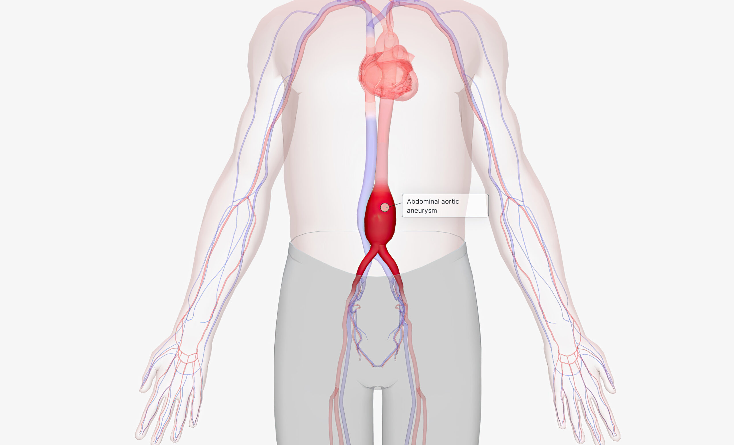 Anévrismes de l aorte abdominale Chirurgie Vasculaire Marseille